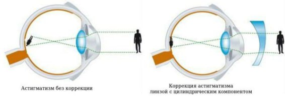 Лечение астигматизма 3