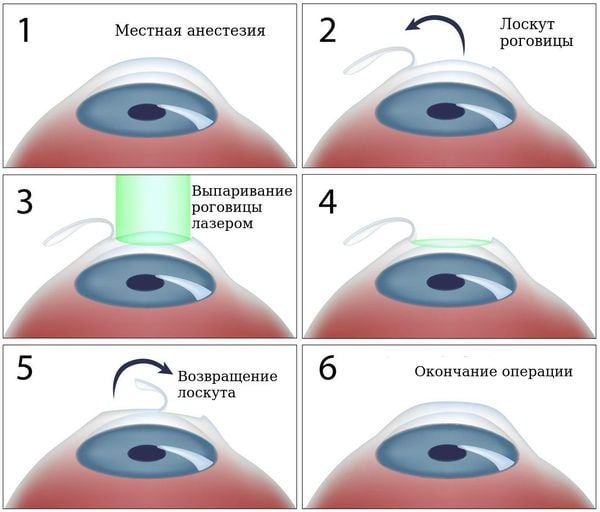 Лечение астигматизма 7