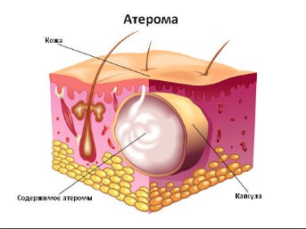 Атерома 3