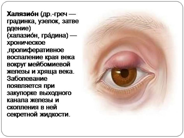 Халязион 1